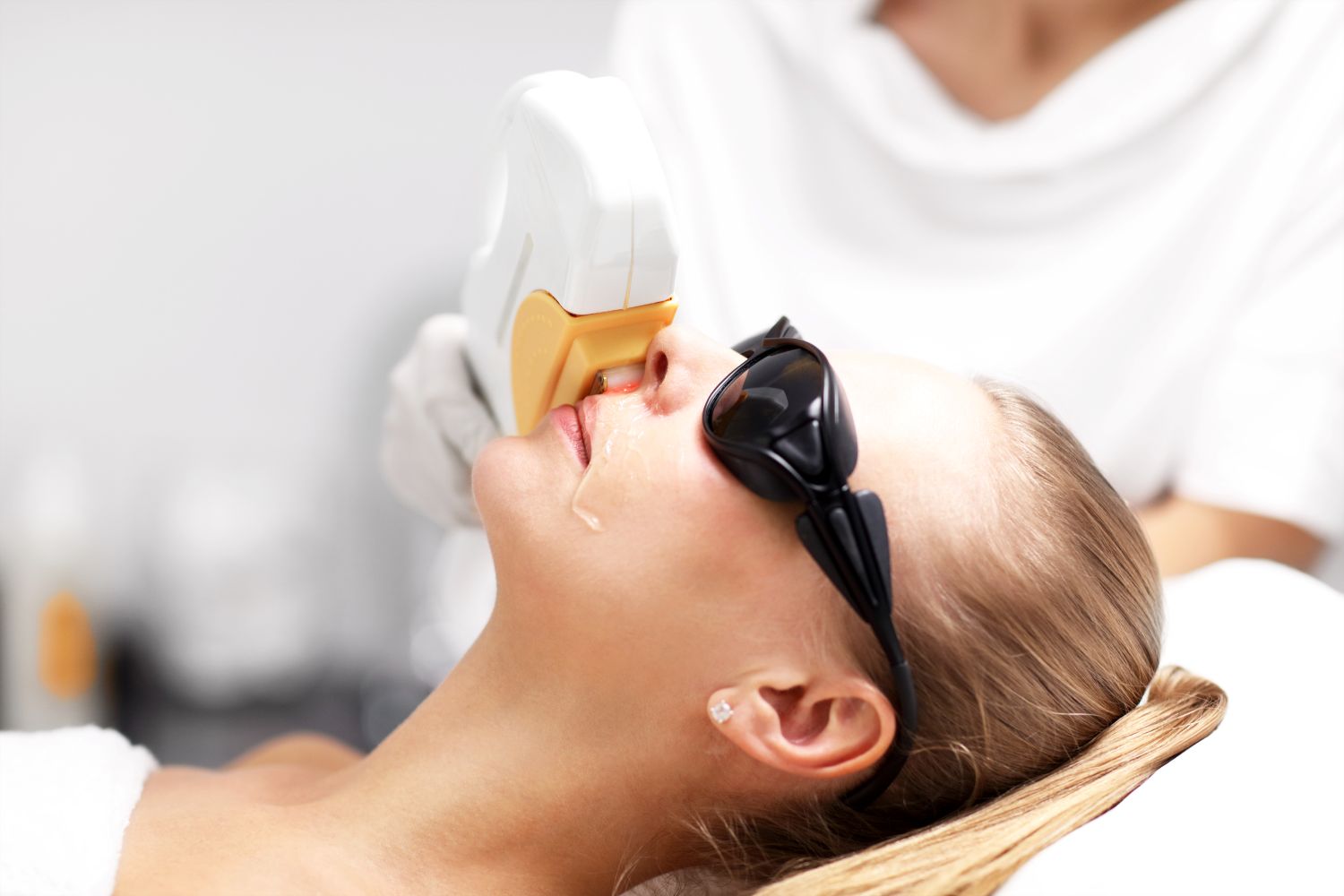 Laser treatment for acne scars