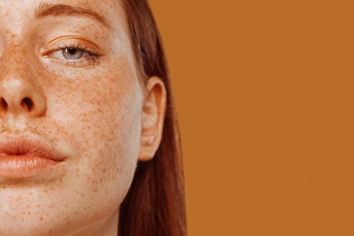 What is melasma